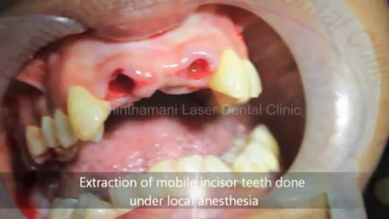 Large gap between upper front teeth treated with BCS Implants