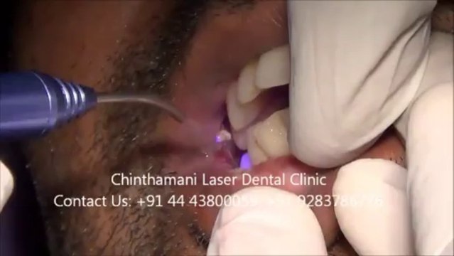 Laser Treatment (Video) for Oral submucous Fibrosis Part -2