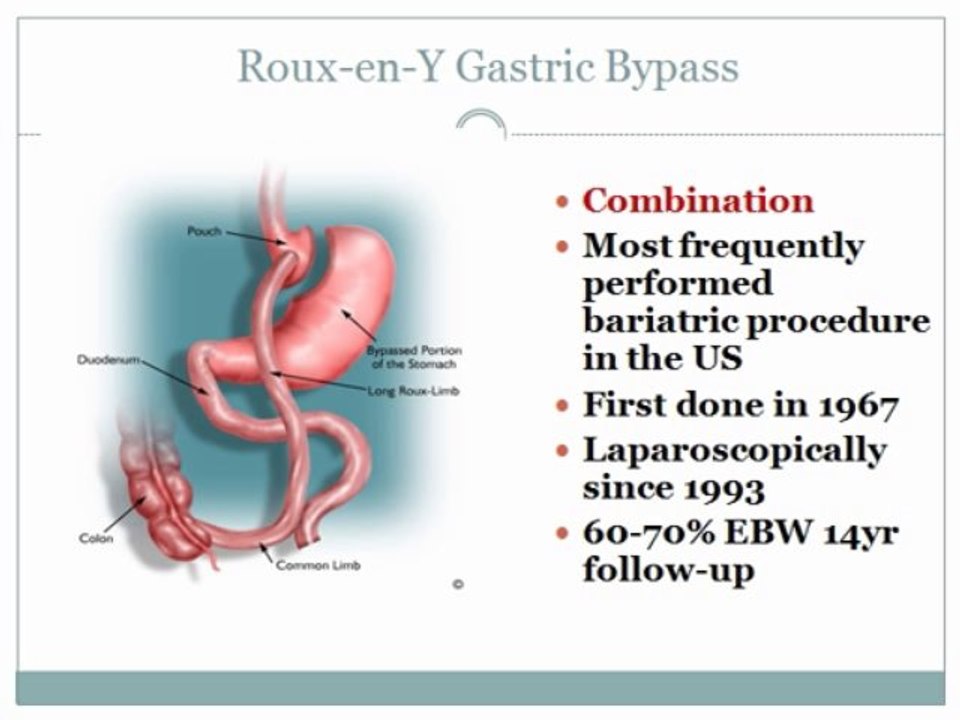Bariatric_surgery