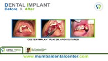 Dental Center in Mumbai | Dental Implants in India