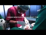 Lip Enhancement Surgery in India