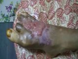 DIABETIC ULCER BETWEEN THE TREATMENT R285 _xvid