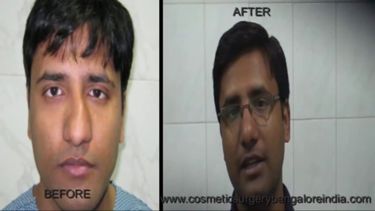 Deviated nose correction, Bangalore, India
