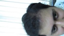 Follicular Unit Transplant (FUT) Hair Transplant Surgery by Satya Hair Transplantation Clinic