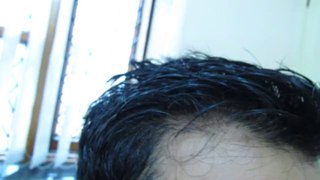 Long Hair Transplantation at Satya Hair Transplantation Clinic