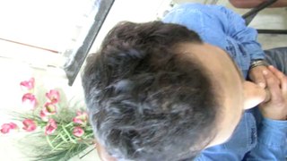 Natural Hair Transplant at Satya hair Transplantstion Clinc