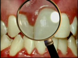 Periodontal-Gum-Disease