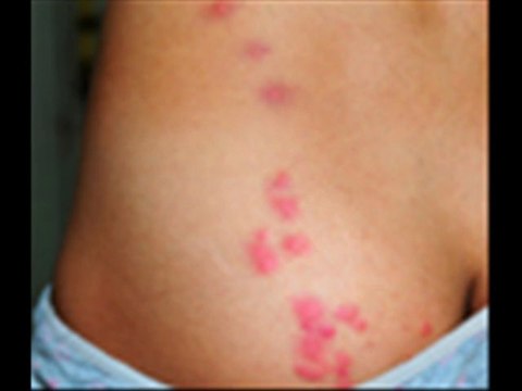 How To Prevent Bed Bugs