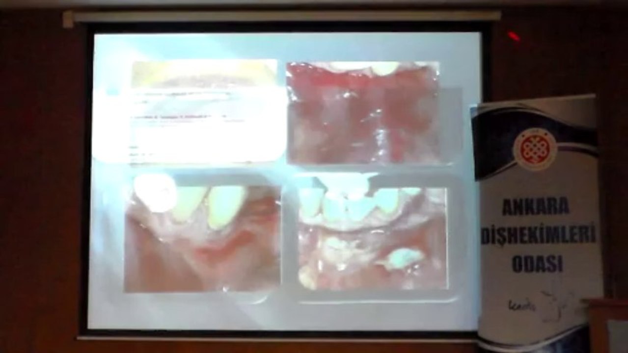 DOÇ.DR.ÖZGÜR TOPUZ 19 ARALIK 2013 ADO EĞİTİM SEMİNERİ 2