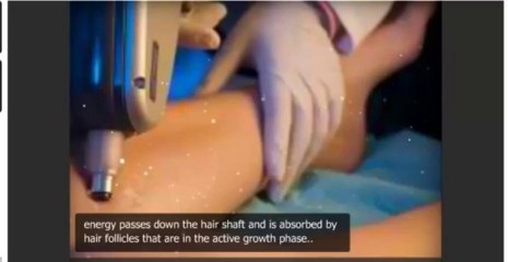 Laser Hair Removal Technique_(480p)