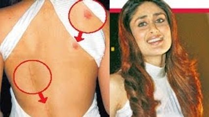 CHECK OUT | Kareena Kapoor Shows Off Her Love Bite On Back