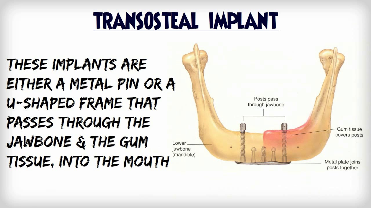 All About Dental Implants