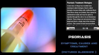 Psoriasis Symptoms, Causes and Treatment Pictures Slideshow -480x360