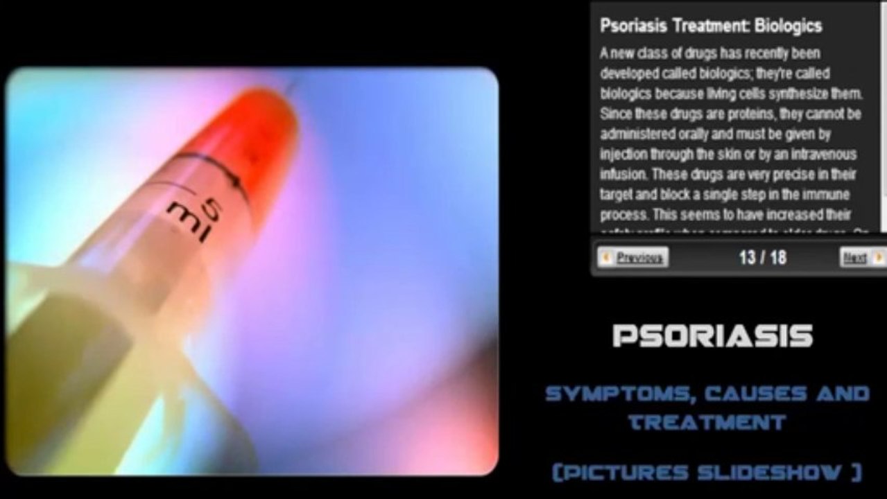 Psoriasis Symptoms, Causes and Treatment Pictures Slideshow -480x360