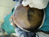 Fue pakistan|Fue in pakistan|Best hair transplant in pakistan