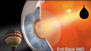 Telescope eye implant restores sight in macular degeneration patients