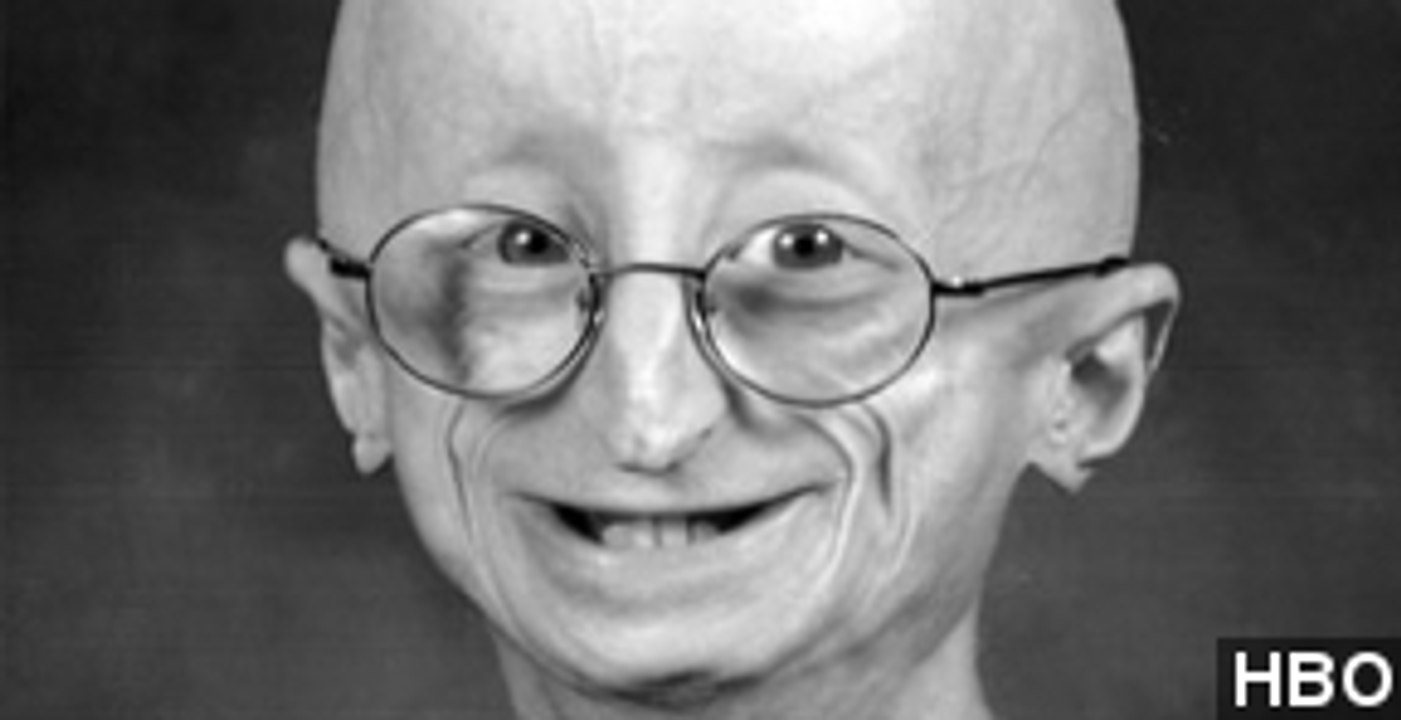 Sam Berns, Teen With Rapid Aging Disease, Dies At 17