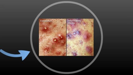 What Is Acne? Causes & Treatments