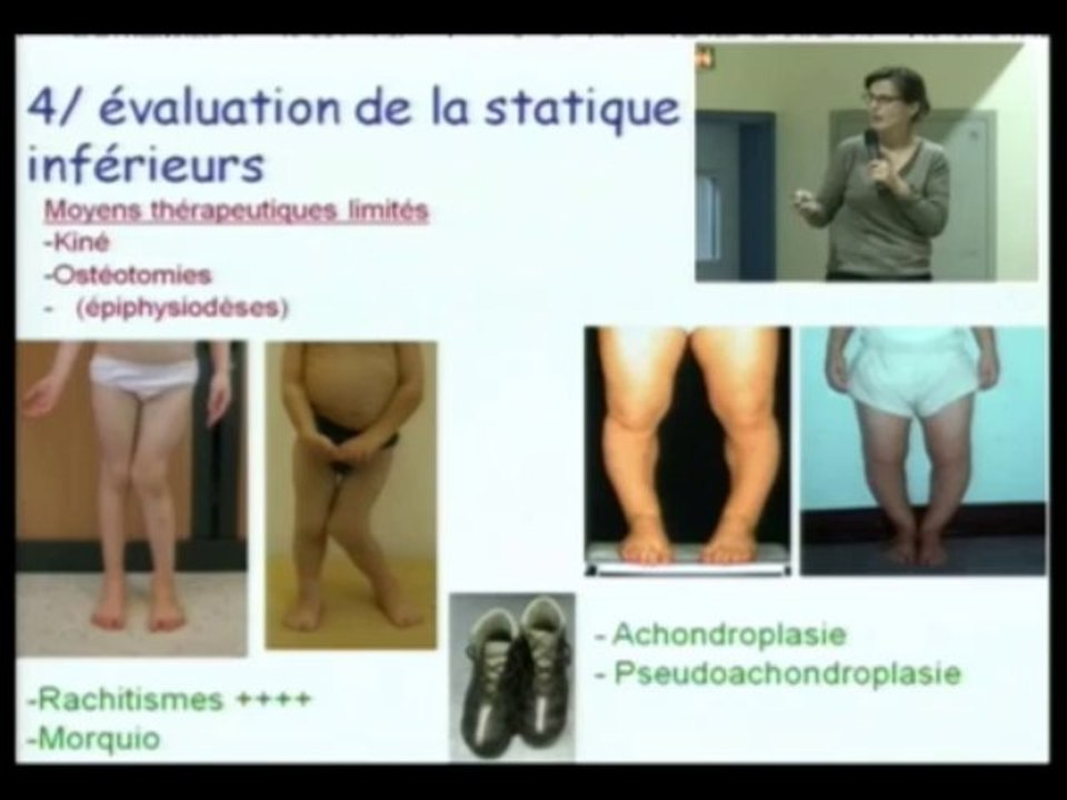 Prise en charge médicale et chirurgicale des personnes de petite taille