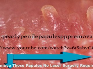 Do Pearly Penile Papules Go Away