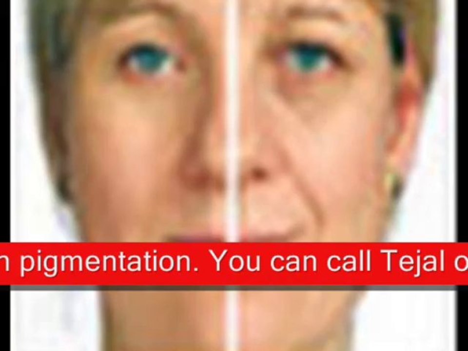 chemical skin peel brighton