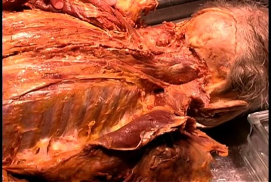 02 - Intrinsic muscles of the back, vertebral column, spinal meninges, spinal cord,