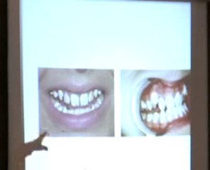 Dr. James Beck Fluoride Discussion