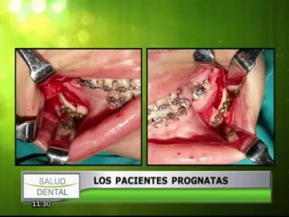 Скачать видео: Salud Dental: ¿Qué tratamientos requieren los pacientes prognatas?