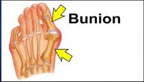 Bunions - Podiatrist in Lutherville, Baltimore,  MD