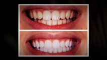 Sonoma Smiles Teeth Whitening- Rohnert Park, CA