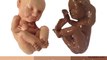 3D Prints of Unborn Fetus From Ultrasound