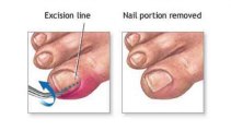 Ingrown Nails - Podiatrist in Baltimore and Lutherville, MD