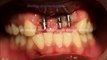 Young patient-Lost teeth in ACCIDENT-FIXED TEETH WITH DENTAL IMPLANTS