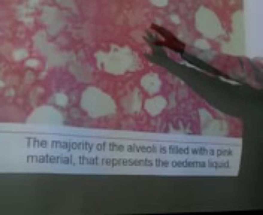 Edema Part 3: Lecture by Dr. Ahmad Din Anjum (Pathology)