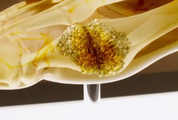 Viện Gút - Y Khoa VGN - What is Gout ???