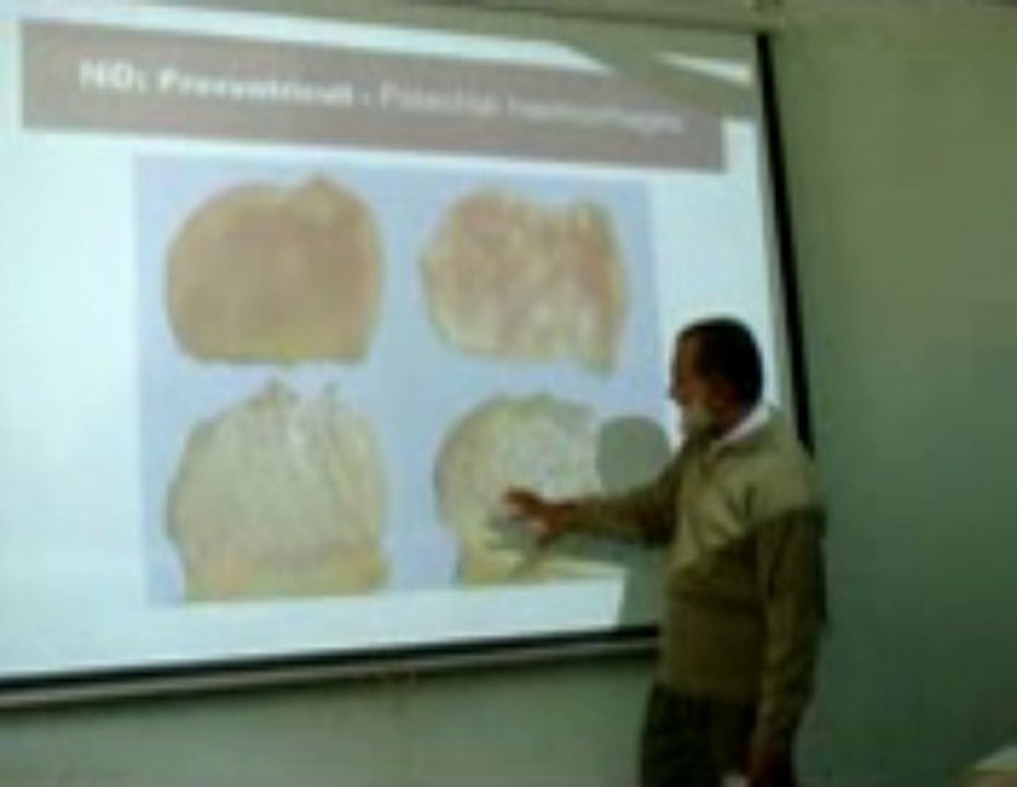Haemorrhage Part 3 ( Terminology & Types): Lecture by Dr. Ahmad Din Anjum (Pathology)
