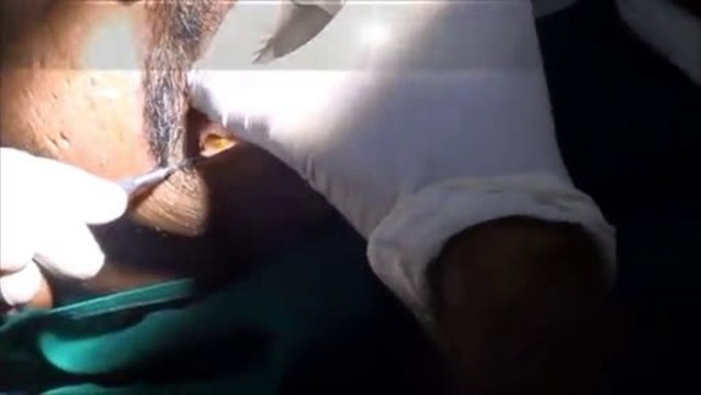 Video of Lower molar teeth replacement with one piece implants-INDIA