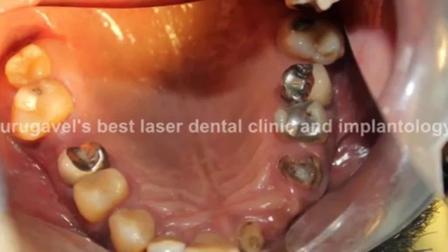 Upper 3 incisors and canine replaced with zirconium bridge with dental implants