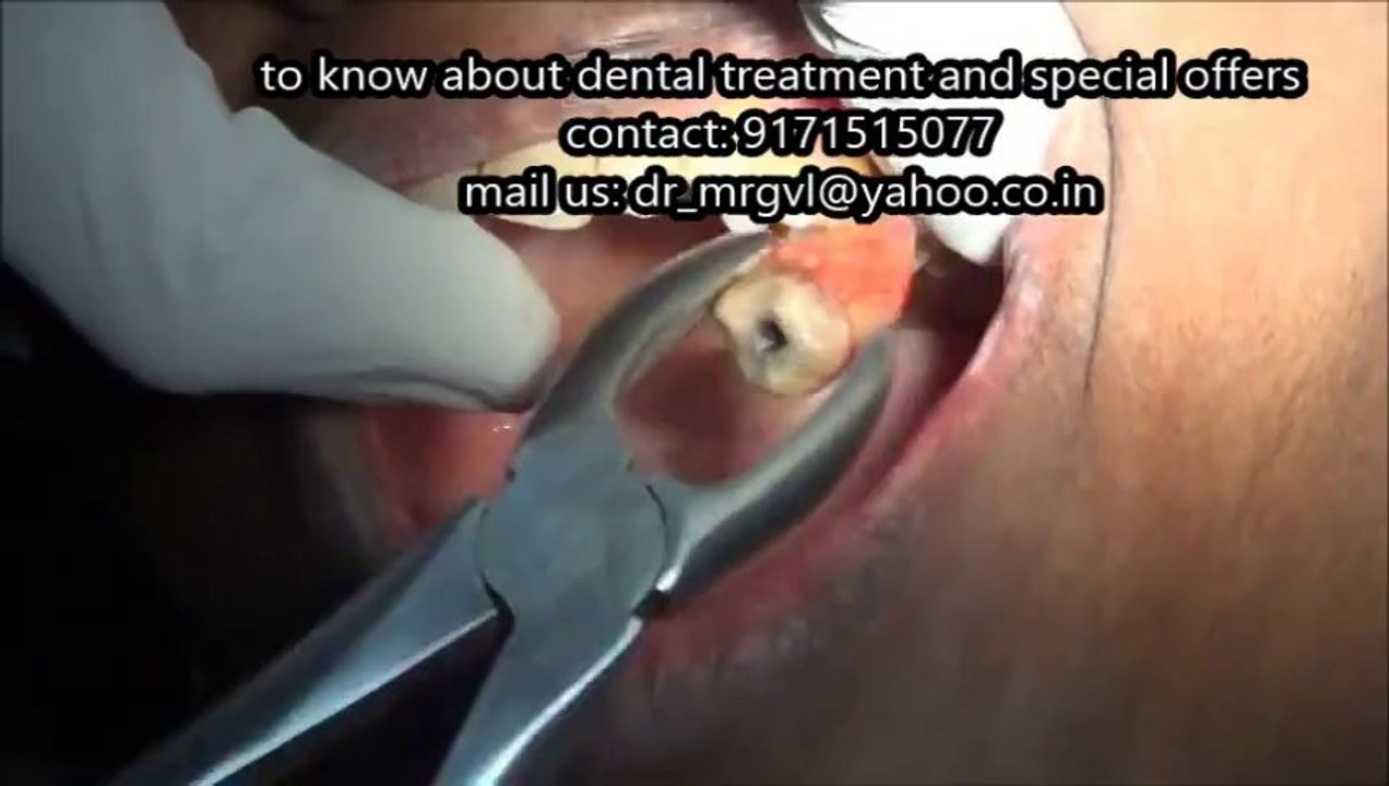 UPPER WISDOM TOOTH EXTRACTION WITH FORCEPS VIDEO