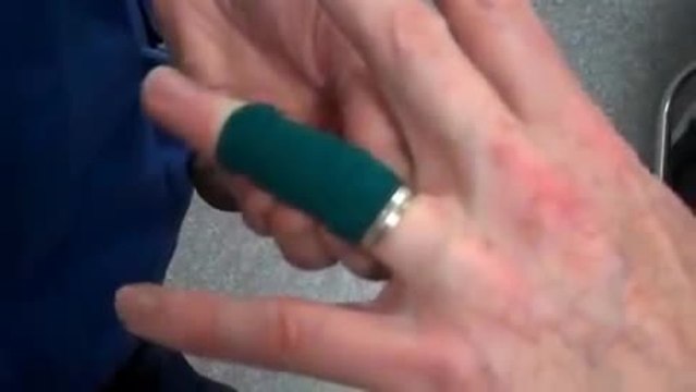 Enlever une bague coincée au doigt