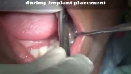 Simple implant video-Dental implant procedure video-Flapless -Lower molar region