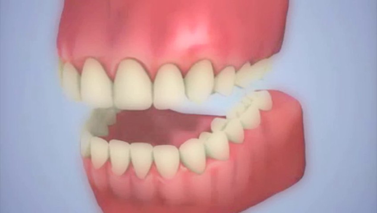 8 greffe osseuse avant implant