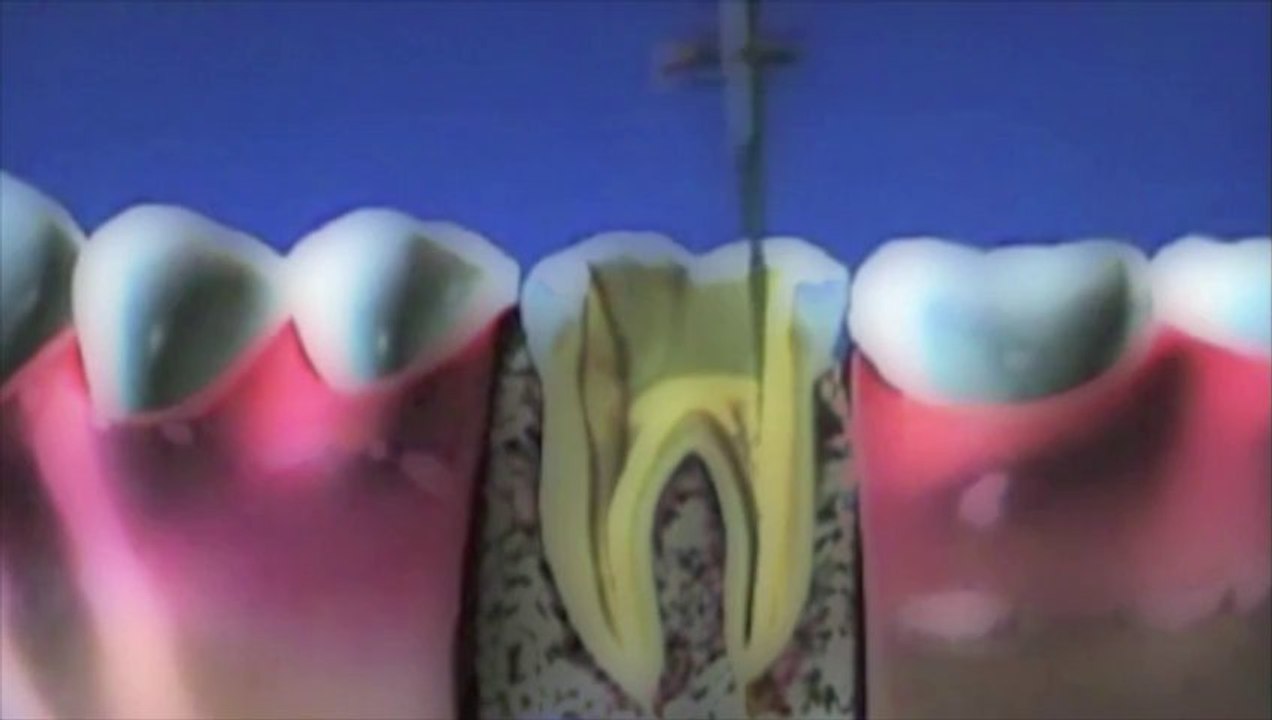 Devitalisation reconstitution couronne