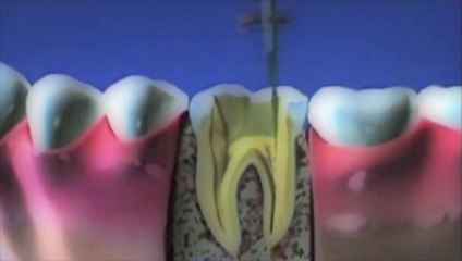 Devitalisation reconstitution couronne