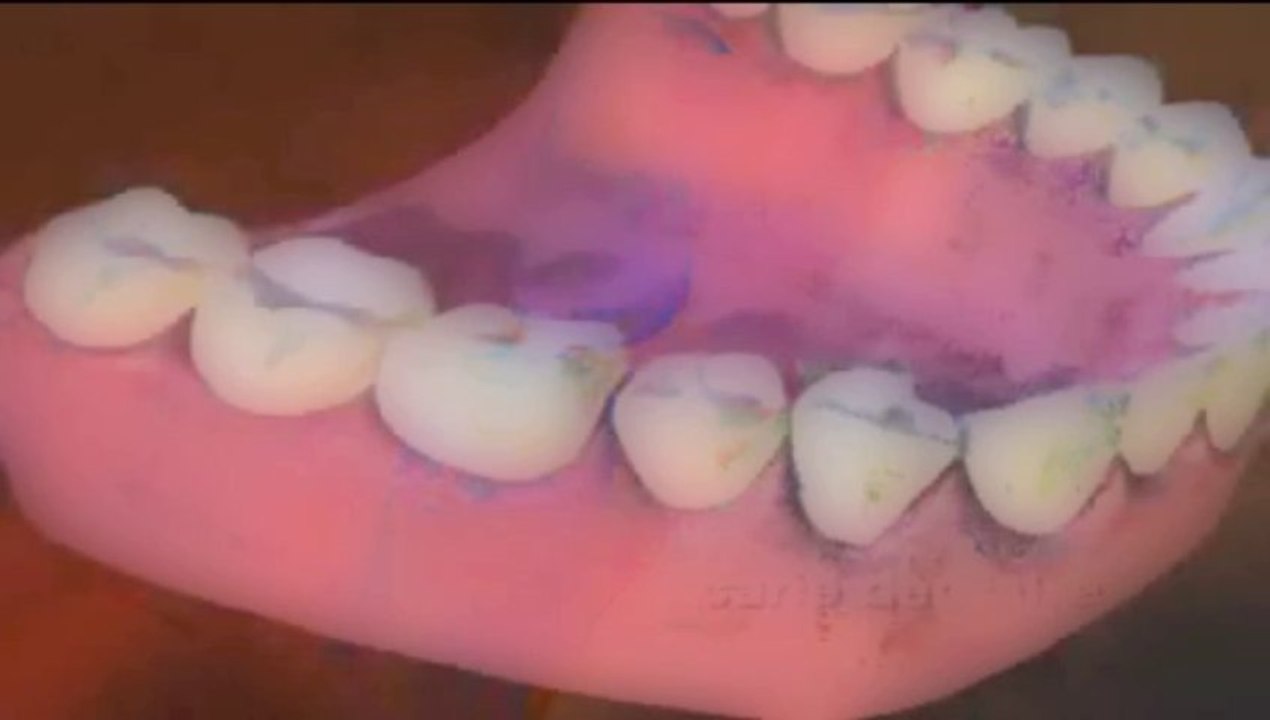 La carie 1 (pour portable) 3