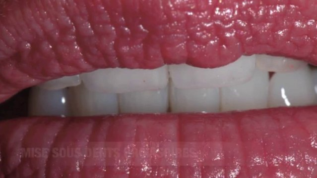 01 Esthétique dentaire, couronnes céramiques zircone antérieures