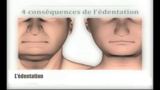 Conséquences Edentation (Moyen) 1