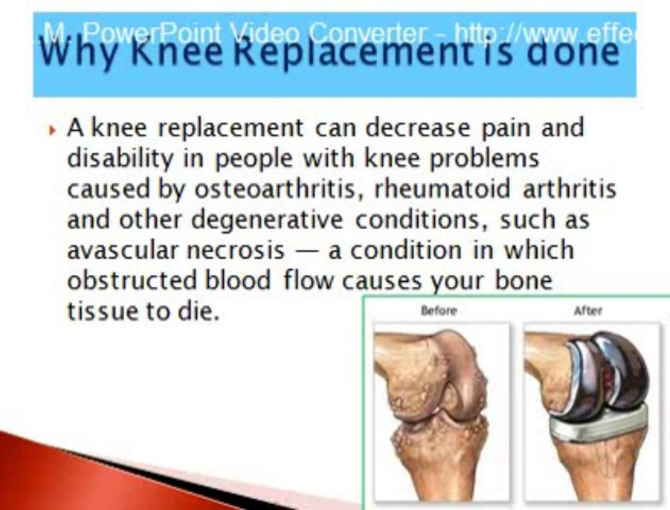Knee Replacement Surgery in India