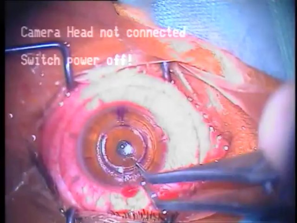 INTACS EYE SURGERY  FOR KERATOCONUS BY DR IRFAN KUNDI