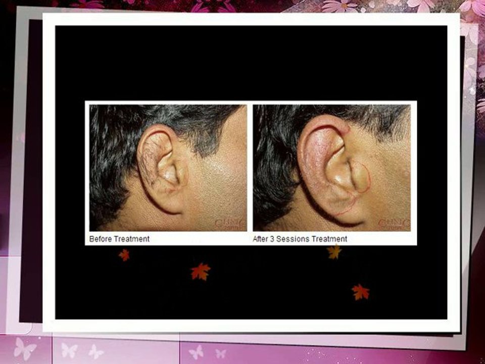 Hair Removal Treatment, Laser Hair Removal Benefits, Side Effects